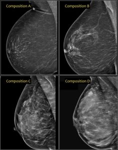ماموگرافی